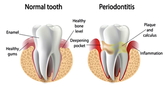 Periodontal disease