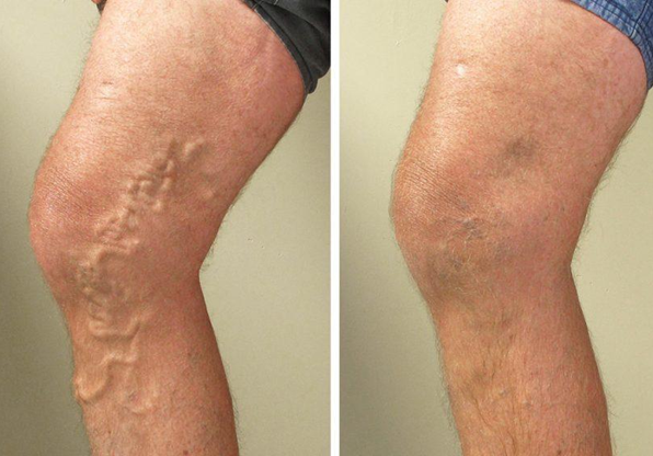 Varicose veins and Ayurvedic methods for their treatment