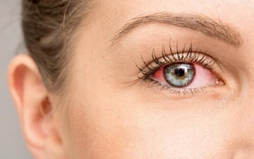 Conjunctivitis according to conventional medicine and Ayurveda