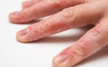 Does Ayurveda heal eczema?